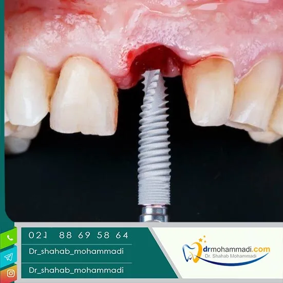 شایع‌ترین عوارض و راه‌های پیشگیری از شکست ایمپلنت
